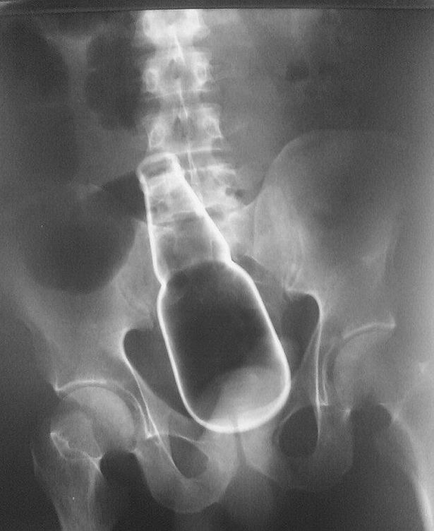 x-ray-butt-03.jpg