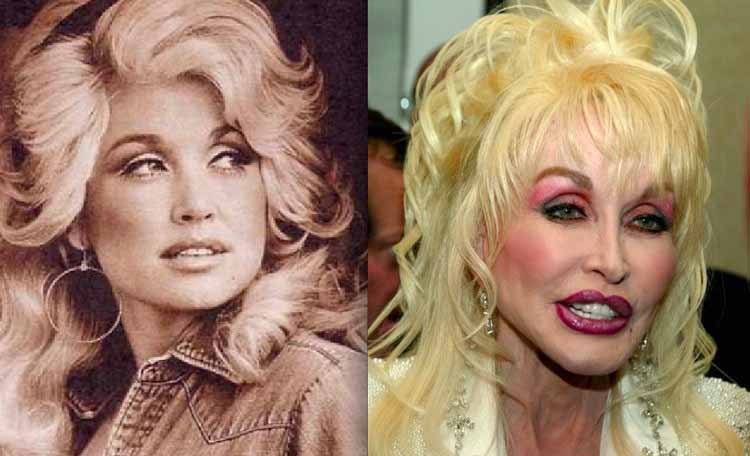 plastic surgery Dolly Parton