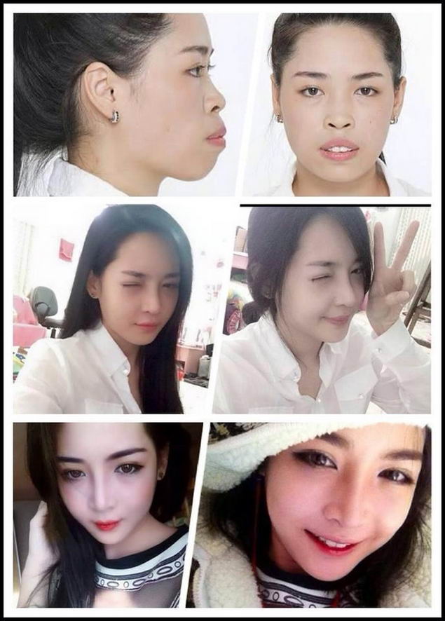 plastic-surgery-vietnam-girl-01