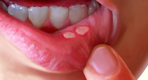 cankersore-mouth-ulcer