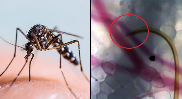 mosquito-bites-1