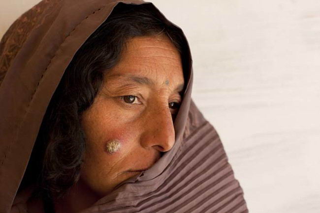 Leishmaniasis Skin Disease Plagues Afghans
