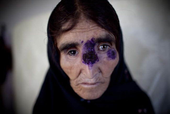Sand-Fly Skin Disease Besets Afghanistan