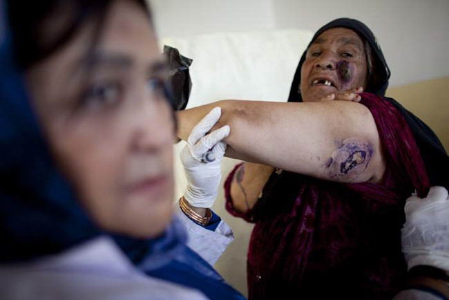Sand-Fly Skin Disease Besets Afghanistan