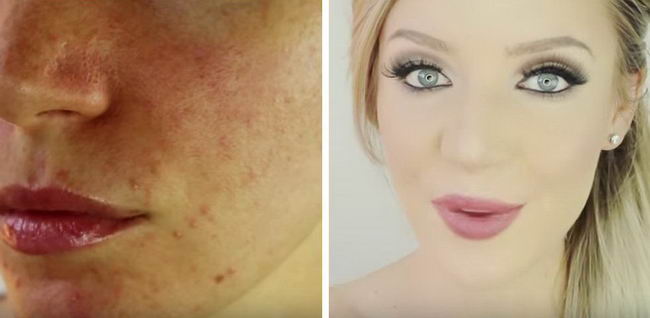 acne-makeup-13