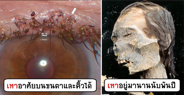 13 ความจริงเกี่ยวกับเหา ที่คุณอาจไม่เคยรู้มาก่อน | เพชรมายา